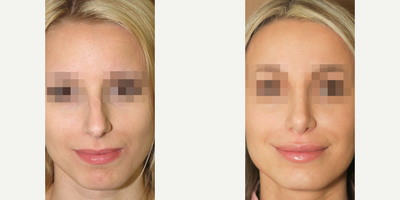 Case 3338 - Woman treated with Rhinoplasty