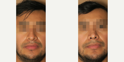 Case 3339 - Man treated with Rhinoplasty
