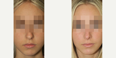 Case 3340 - Woman treated with Rhinoplasty