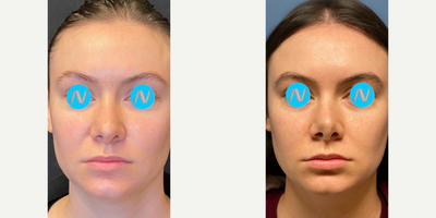 Case 3341 - Woman treated with Rhinoplasty