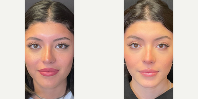 Case 3342 - Woman treated with Rhinoplasty