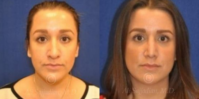 Case 3343 - Rhinoplasty