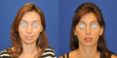 Case 3344 - Rhinoplasty