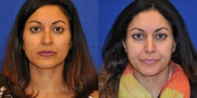 Case 3345 - Rhinoplasty