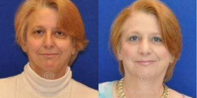 Case 3346 - Rhinoplasty