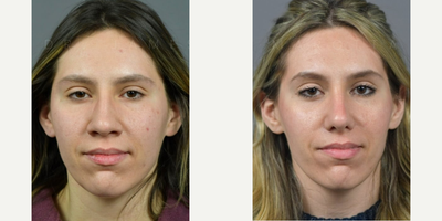 Case 3347 - Woman treated with Rhinoplasty