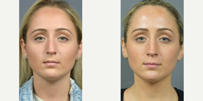 Case 3348 - Woman treated with Rhinoplasty