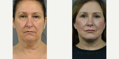 Case 3349 - Woman treated with Rhinoplasty