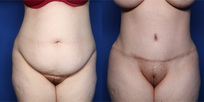 Case 335 - 25-34 year old woman treated with Tummy Tuck