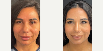 Case 3350 - Woman treated with Rhinoplasty