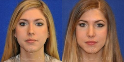 Case 3351 - Rhinoplasty