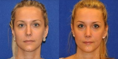 Case 3352 - Rhinoplasty