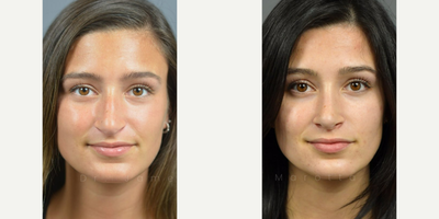 Case 3353 - Woman treated with Rhinoplasty