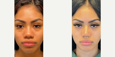 Case 3354 - Woman treated with Rhinoplasty