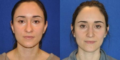 Case 3355 - Woman treated with Rhinoplasty