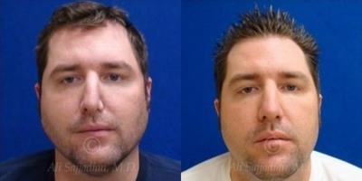 Case 3356 - Man treated with Rhinoplasty