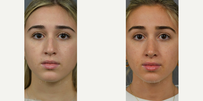 Case 3357 - Woman treated with Rhinoplasty