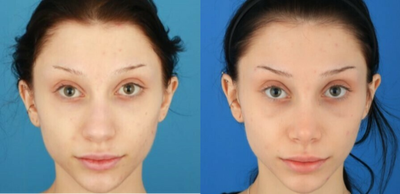 Case 3359 - 18-24 year old woman treated with Rhinoplasty
