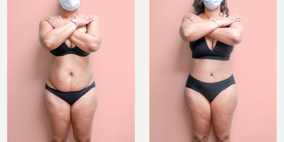 Case 336 - 35-44 year old woman treated with Tummy Tuck, Liposuction