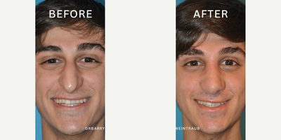 Case 3360 - Man treated with Rhinoplasty