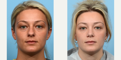 Case 3361 - 25-34 year old woman treated with Rhinoplasty