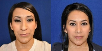 Case 3362 - Rhinoplasty
