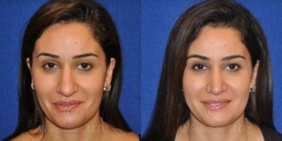 Case 3363 - Rhinoplasty