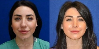 Case 3364 - Rhinoplasty