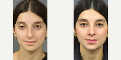 Case 3365 - Rhinoplasty