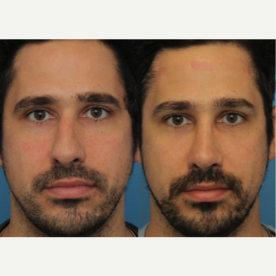 Case 3366 - 25-34 year old man treated with Rhinoplasty