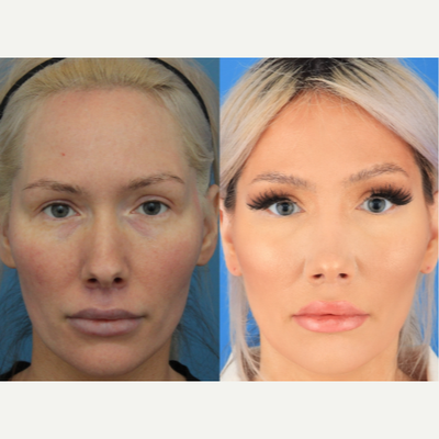 Case 3367 - 35-44 year old woman treated with Rhinoplasty