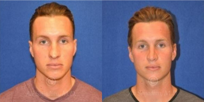 Case 3369 - Rhinoplasty