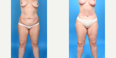 Case 337 - Woman treated with Tummy Tuck