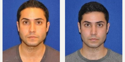 Case 3370 - Rhinoplasty