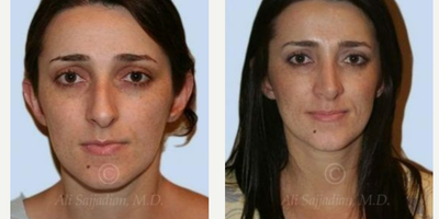 Case 3371 - Rhinoplasty