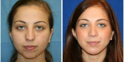 Case 3372 - Rhinoplasty