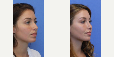 Case 3373 - Woman treated with Rhinoplasty