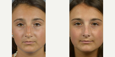 Case 3374 - Woman treated with Rhinoplasty