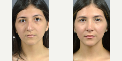 Case 3375 - Woman treated with Rhinoplasty