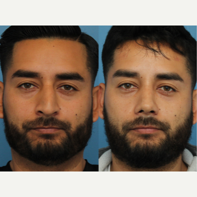 Case 3376 - 25-34 year old man treated with Rhinoplasty