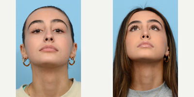 Case 3377 - 18-24 year old woman treated with Rhinoplasty