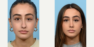 Case 3378 - 18-24 year old woman treated with Rhinoplasty