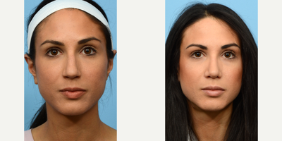 Case 3379 - 25-34 year old woman treated with Rhinoplasty