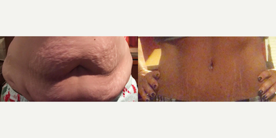 Case 338 - Woman treated with Tummy Tuck