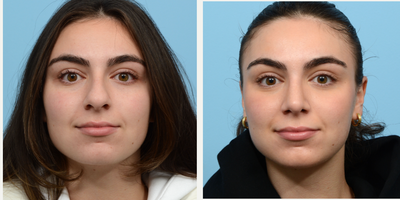 Case 3382 - 18-24 year old woman treated with Rhinoplasty