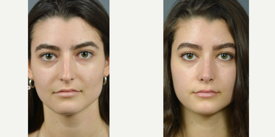 Case 3383 - Rhinoplasty