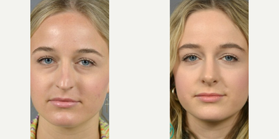 Case 3384 - Woman treated with Rhinoplasty