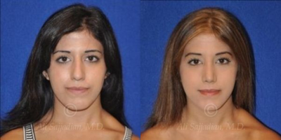 Case 3385 - Rhinoplasty