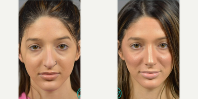 Case 3388 - Woman treated with Rhinoplasty, Septoplasty
