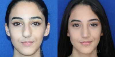 Case 3389 - Rhinoplasty